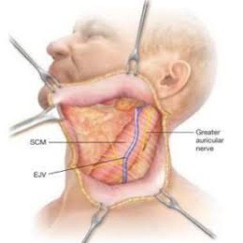 Neck Dissection in Bhagalpur
