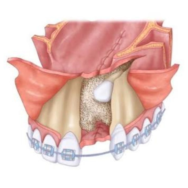Alveolar Bone Grafting in Bhagalpur