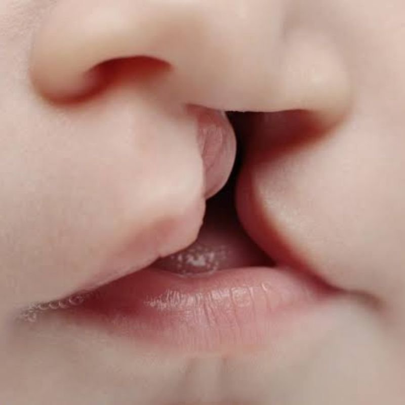 Cleft Lip Repair in Bhagalpur