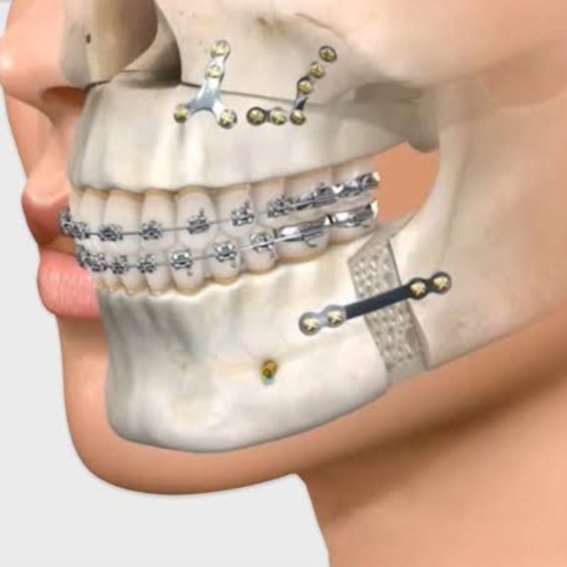 Secondary & Revision Surgery in Bhagalpur