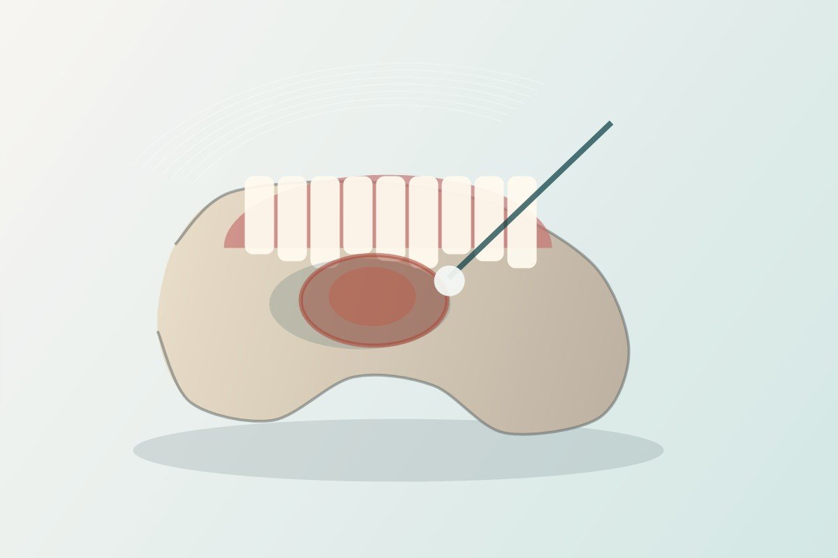 Osteomyelitis of the jaw bone treatment in Bhagalpur