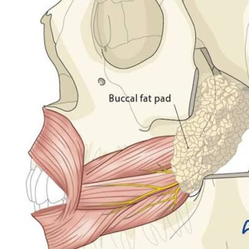 Buccal Fat Pad Graft in Bhagalpur