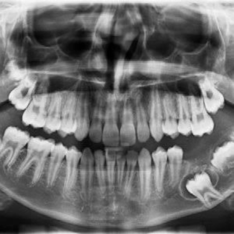 Surgical Debridement (Sequestrectomy) in Bhagalpur