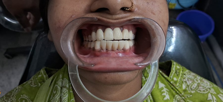 After dental treatment