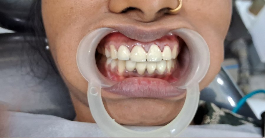 After dental treatment