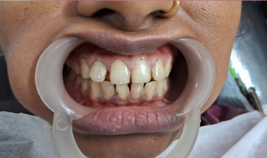 Before dental treatment