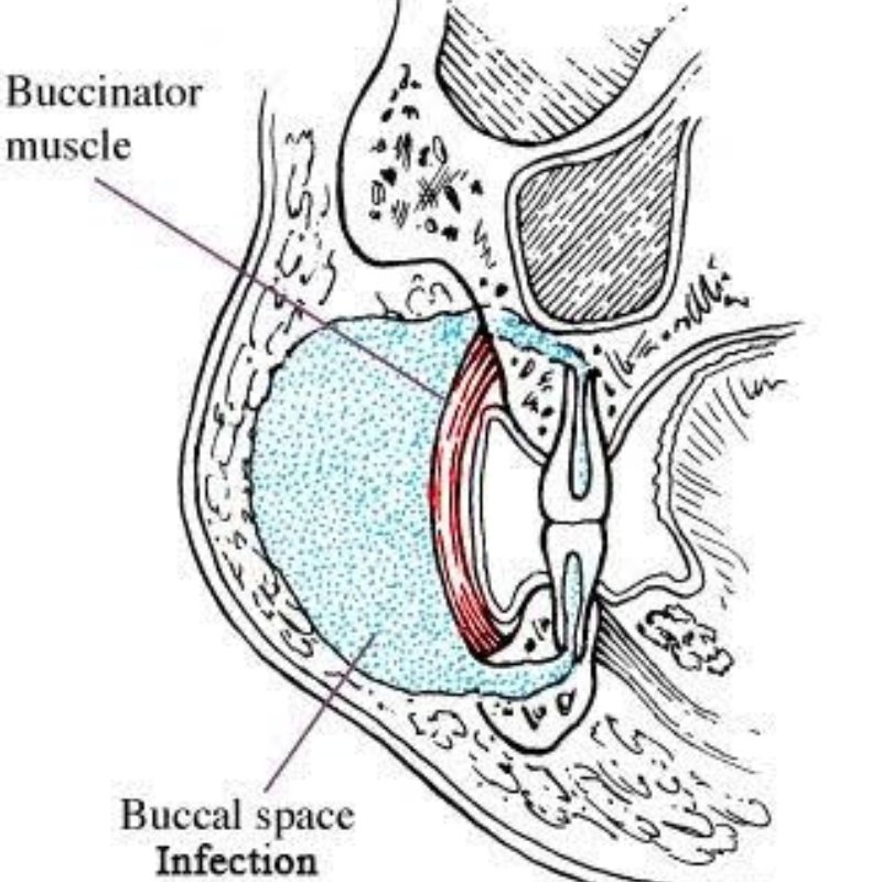 Buccal Space Infection in Bhagalpur