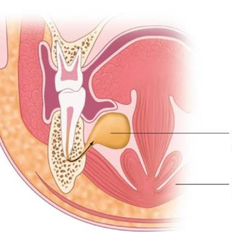 Sublingual Space Infection in Bhagalpur
