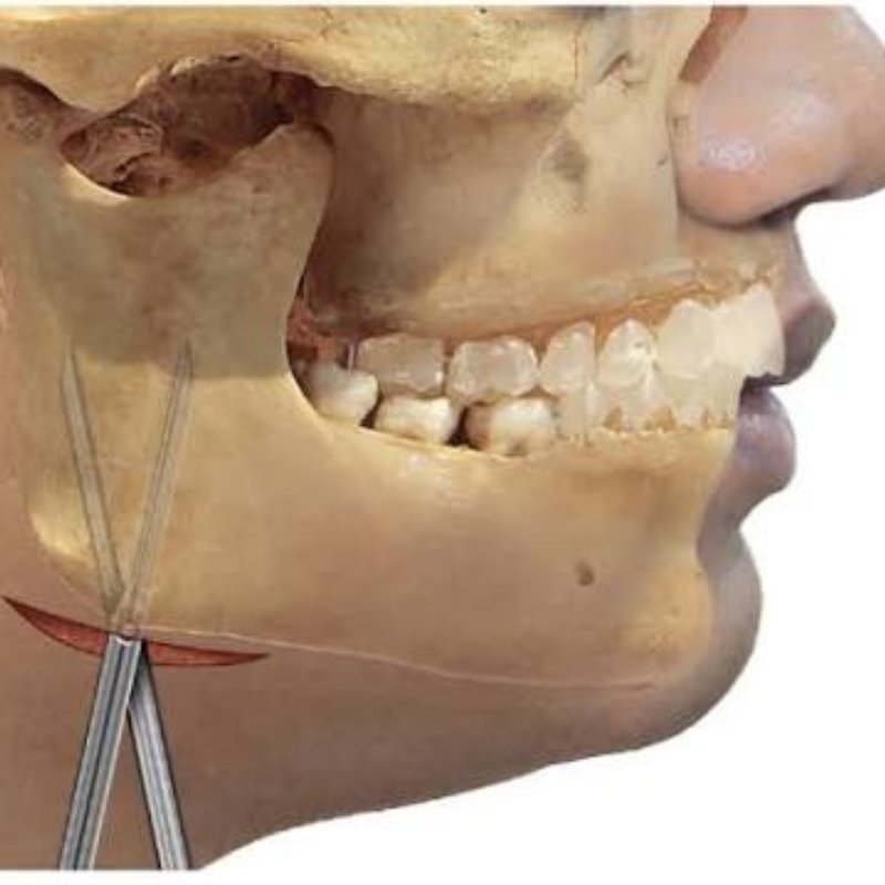 Submandibular Space Infection in Bhagalpur