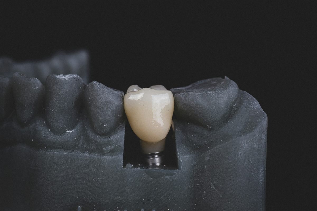 Dental crowns and bridges in Bhagalpur