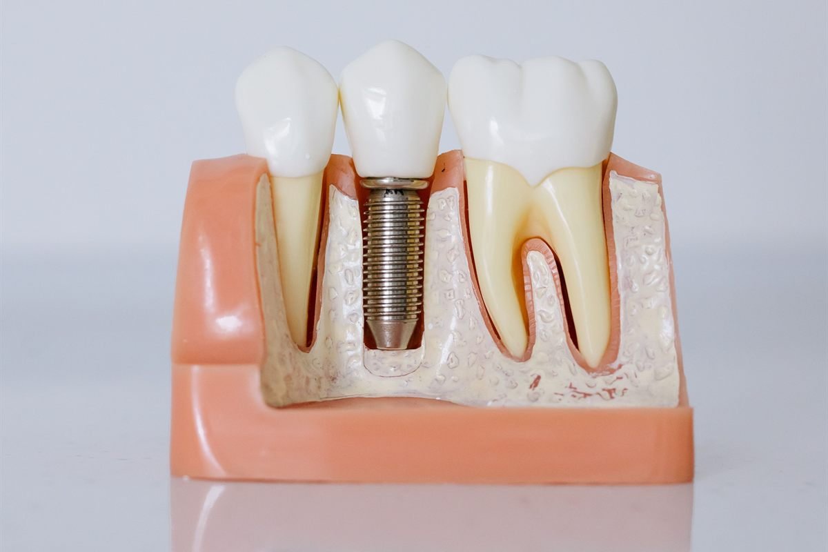 Dental Implants at Khushi Dental Care