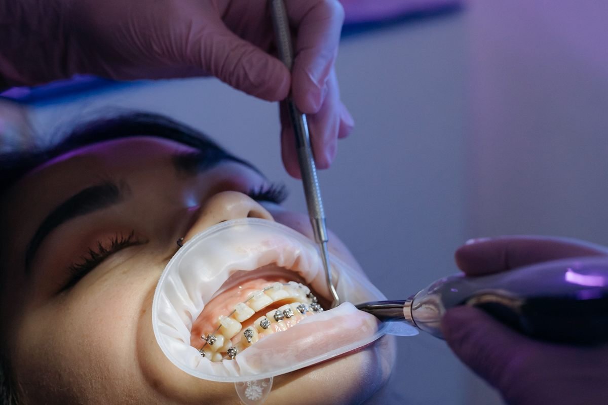 Braces and clear aligners treatment in Bhagalpur
