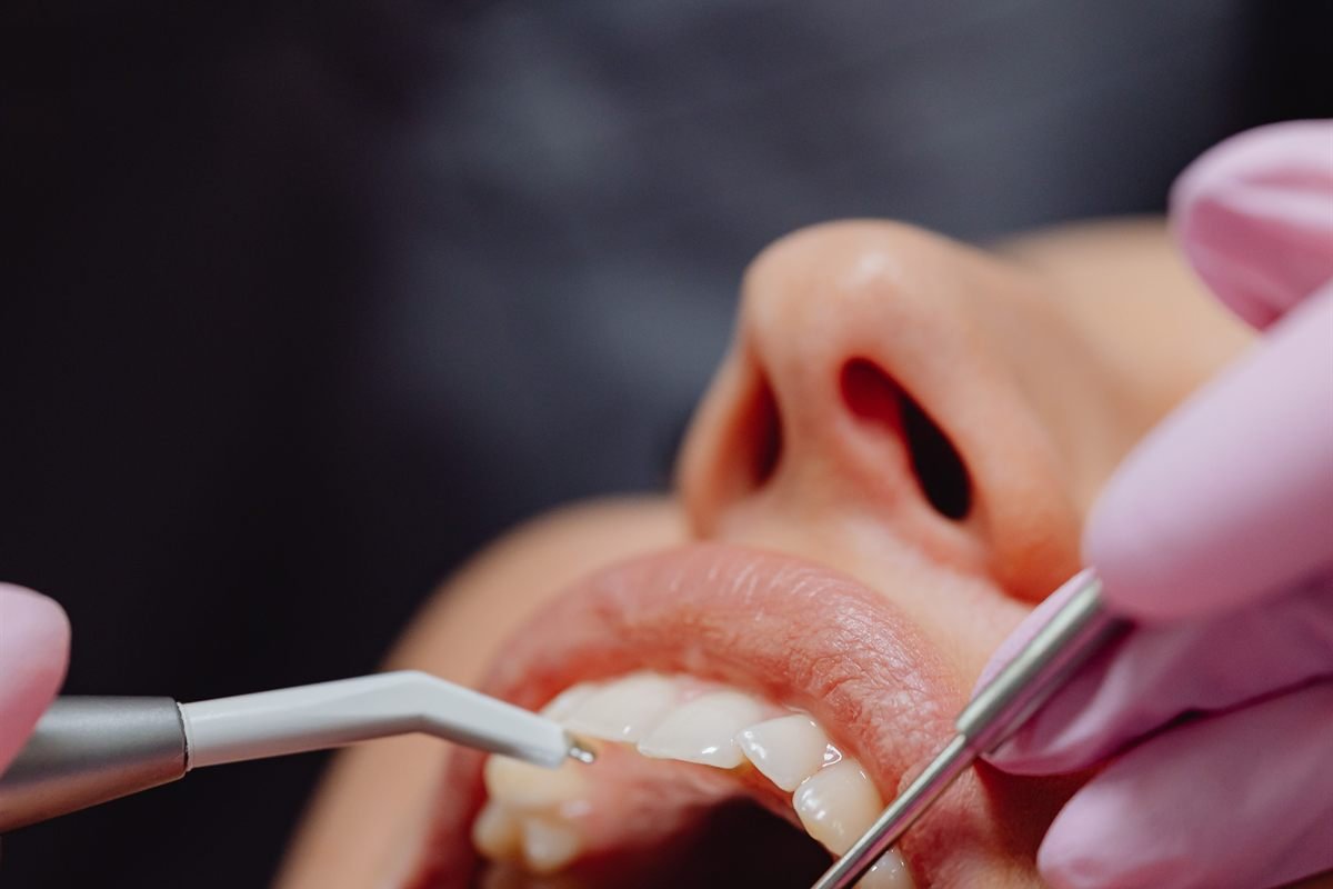Gum disease and periodontal treatment in Bhagalpur