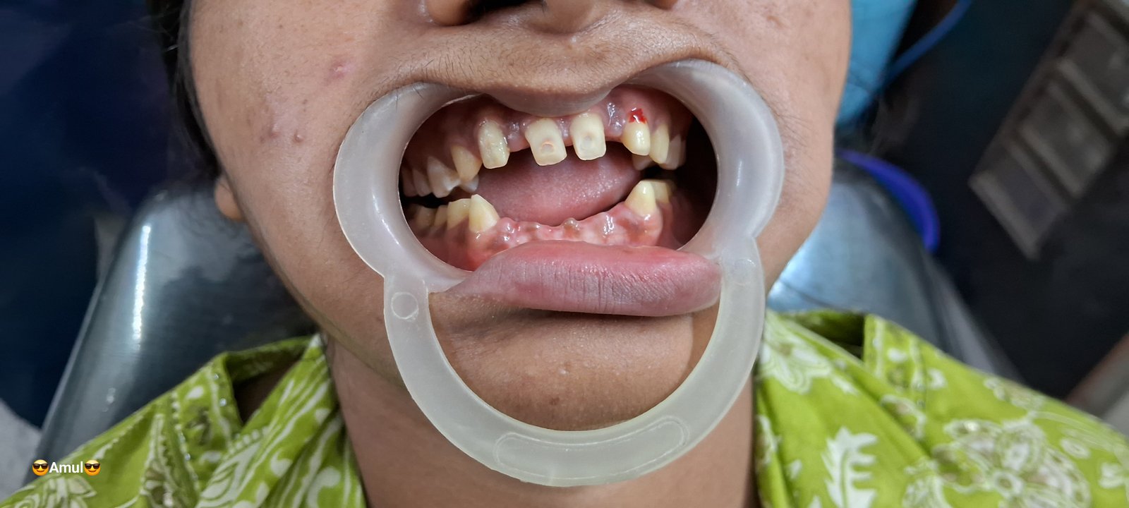 Before dental treatment