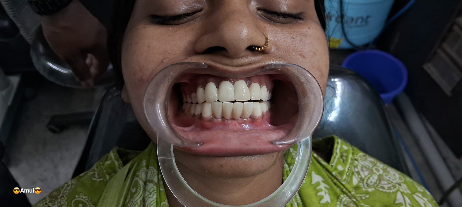 After dental treatment