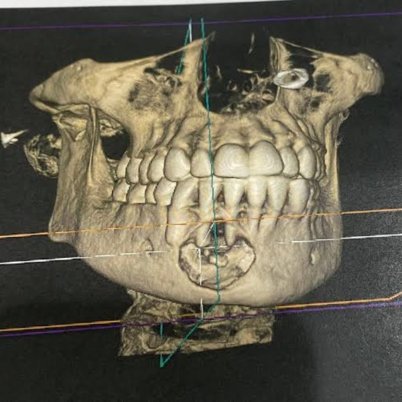 Benign Jaw Tumour Removal in Bhagalpur