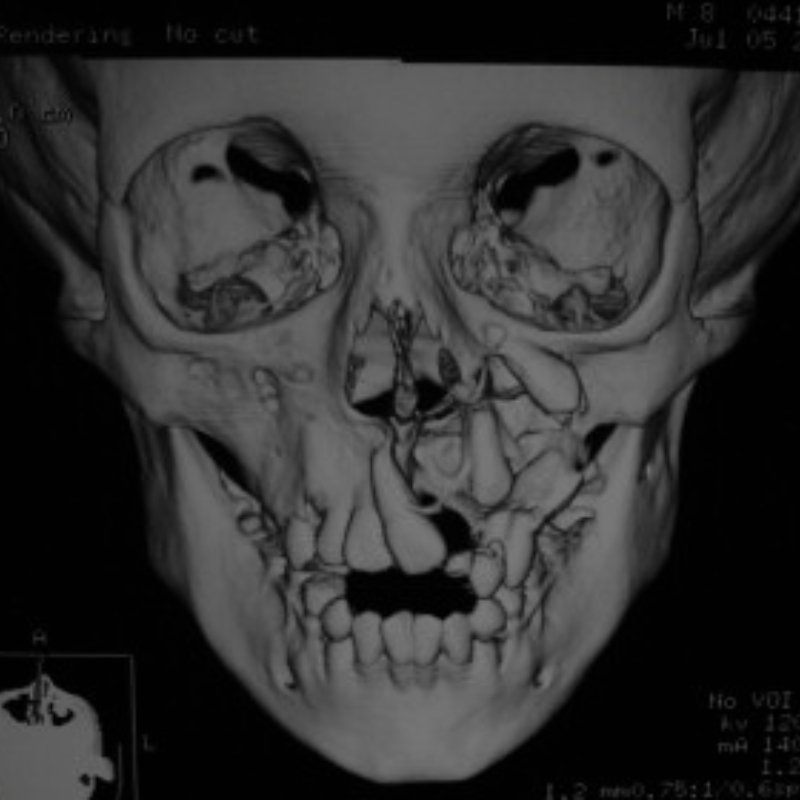 Odontogenic Cysts in Bhagalpur