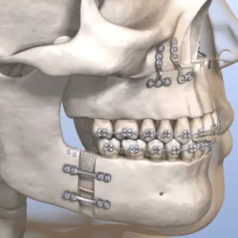 Reconstruction After Tumour Removal in Bhagalpur